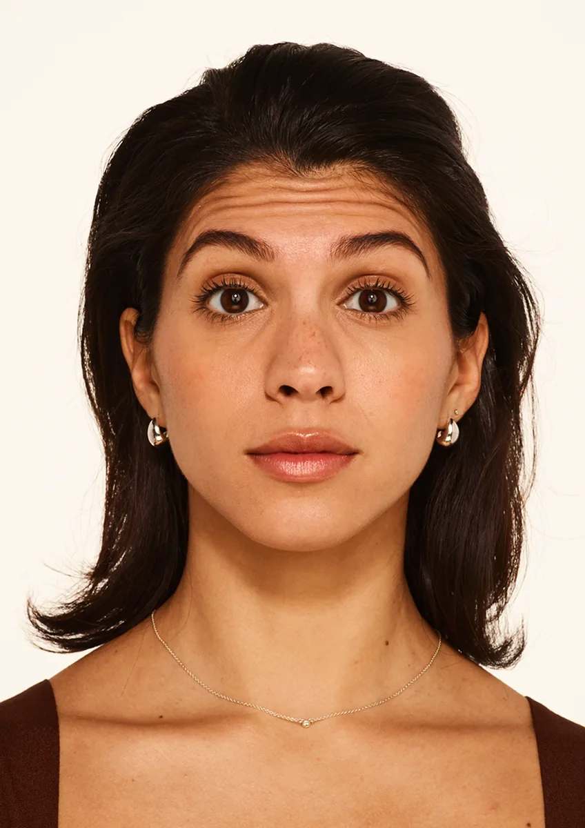 Nicole, paciente apresentada pelo fabricante BOTOX Cosmetic, antes do tratamento, com as sobrancelhas elevadas